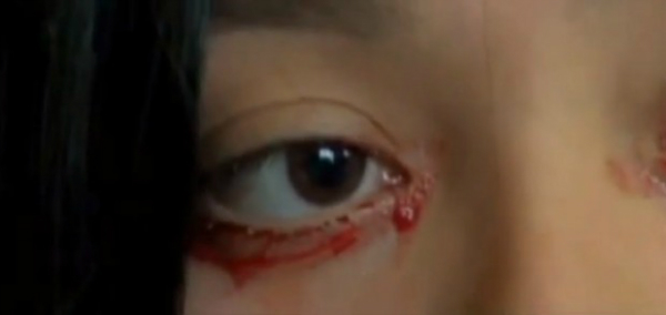 20-ամյա աղջկա աչքերից արցունքի փոխարեն արյուն է գալիս (Տեսանյութ)