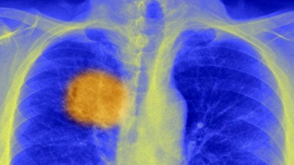 Բրիտանացի գիտնականները խոստանում են, որ շուտով քաղցկեղը մեկ ներարկումով կբուժեն. BBC
