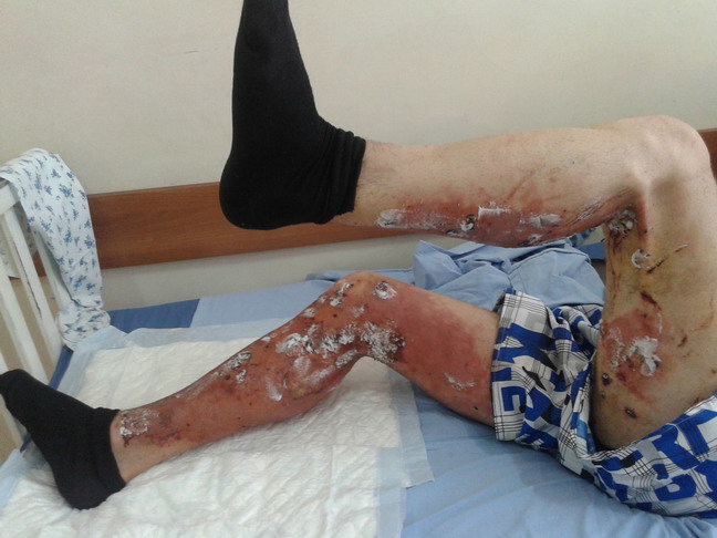 Գեւորգի երկու ոտքն էլ խորն այրվածքներ են ստացել լուսաձայնային նռնակի պայթյունից: