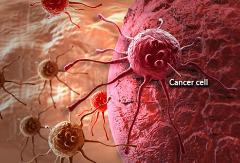 ԻՆչպե՞ս կանխել քաղցկեղի 13 տեսակների առաջացման վտանգը