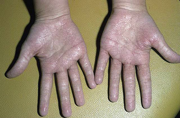 Ինչո՞ւ է երեխաների  ձեռքերը միշտ քրտնած