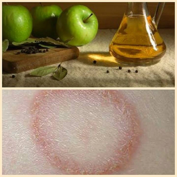 Չնոսրացրած խնձորի քացախի օգնությամբ կարող եք բուժել մաշկ սնկային հիվանդությունը