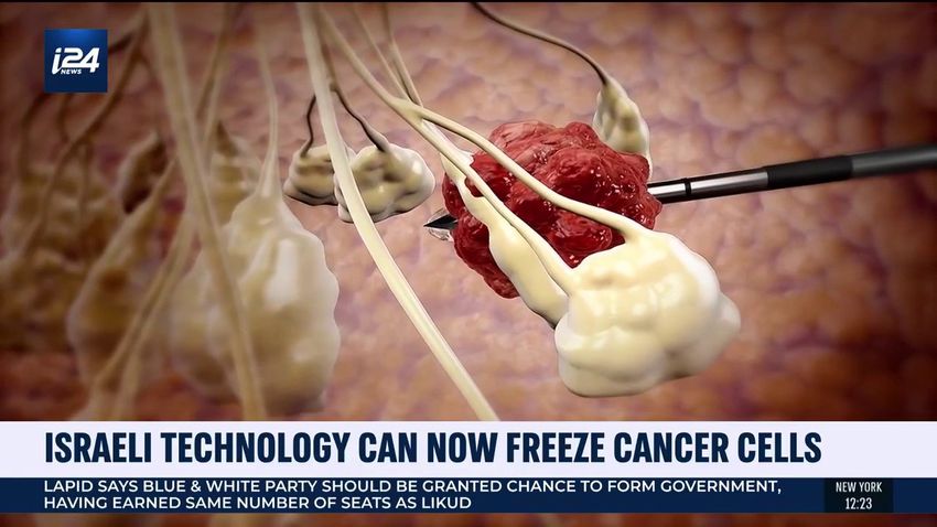 Իսրայելական նոր տեխնոլոգիան այժմ կարող է սառեցնել քաղցկեղի բջիջները