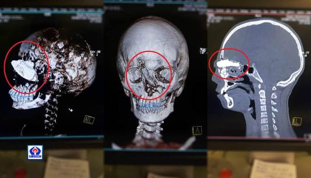 Անկյունային հղկիչը կոտրվել է ու հայտնվել երեխայի գլխում. տղան վիրահատվել է