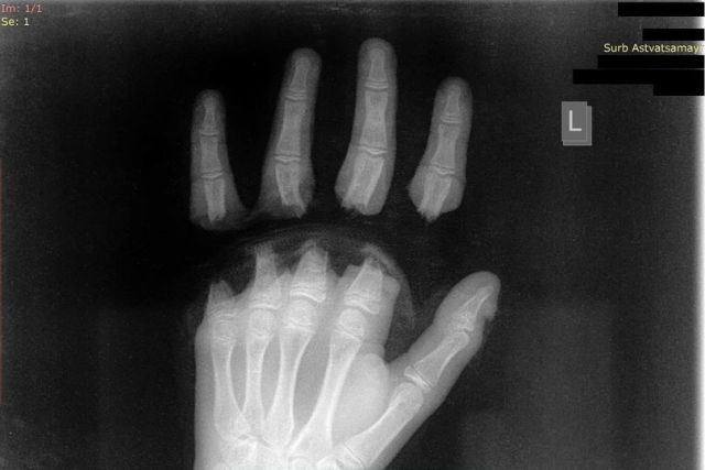 Երեխան 10 ժամ վիրահատվել է, պլաստիկ վիրաբույժները կատարել են ձեռքի մատների ռեպլանտացիա