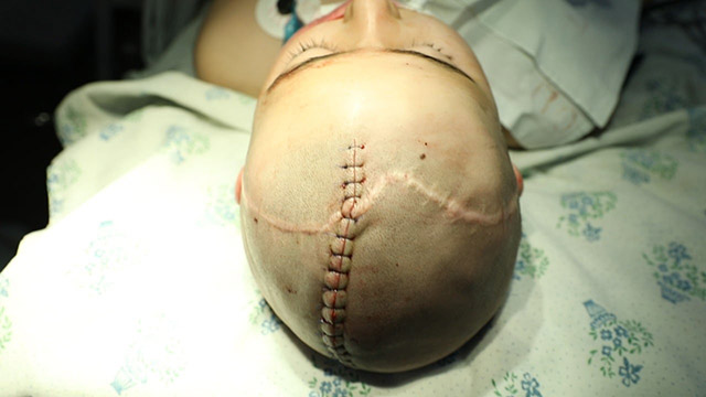 Աննախադեպ վիրահատություն «Սուրբ Աստվածամայր» ԲԿ-ում. Կատարվել է գանգի դեֆեկտի պլաստիկա՝ տիտանե կոնստրուկցիայով️