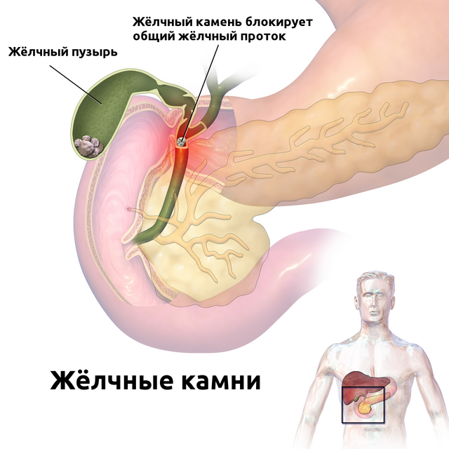 Քարեր լեղապարկում